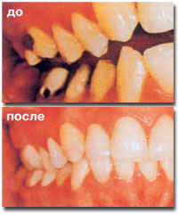 Зубное протезирование.коронки